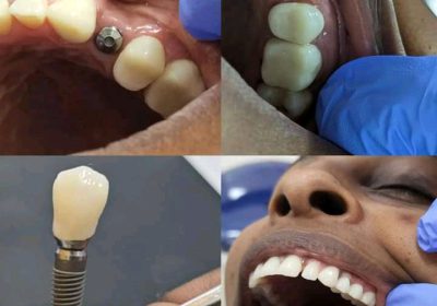 Dental implants kampala