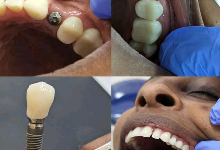 Dental implants kampala