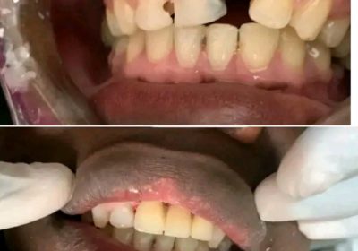 Teeth treatment Uganda
