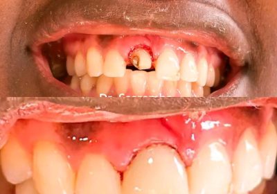 Dental treatment kampala