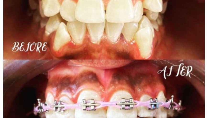 Teeth alignment in Uganda
