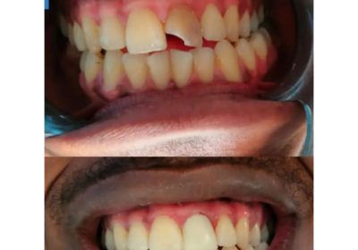 Dental crowning kampala