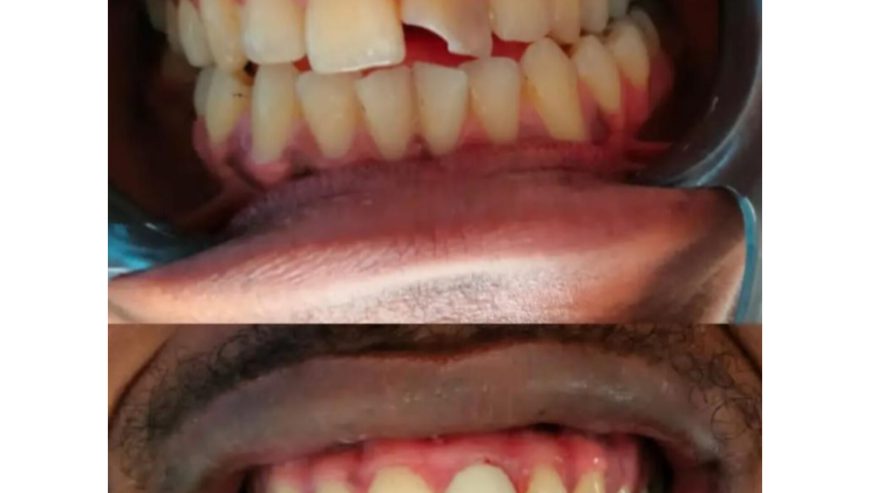 Dental crowning kampala