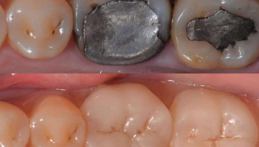 Teeth fillings kampala Uganda