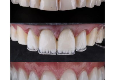 Artificial teeth in kampala