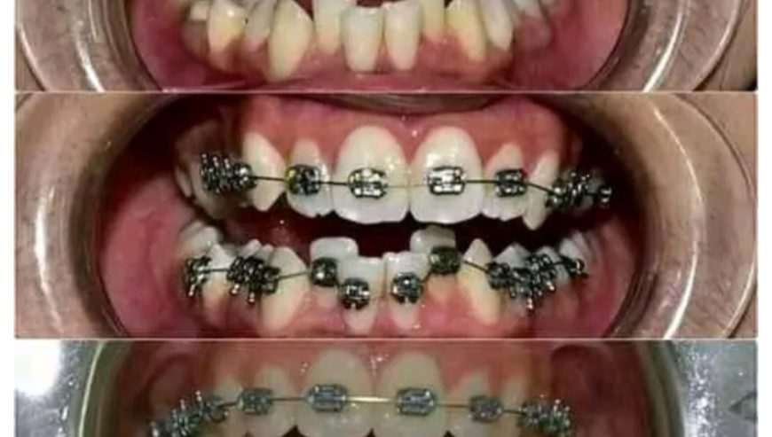 Dental braces in Uganda