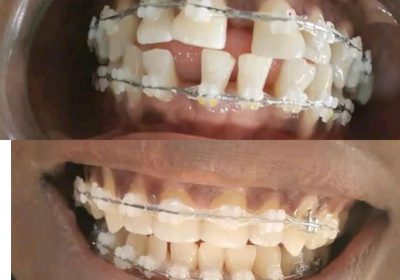 braces treatment Uganda