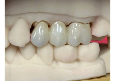 Teeth replacement kampala