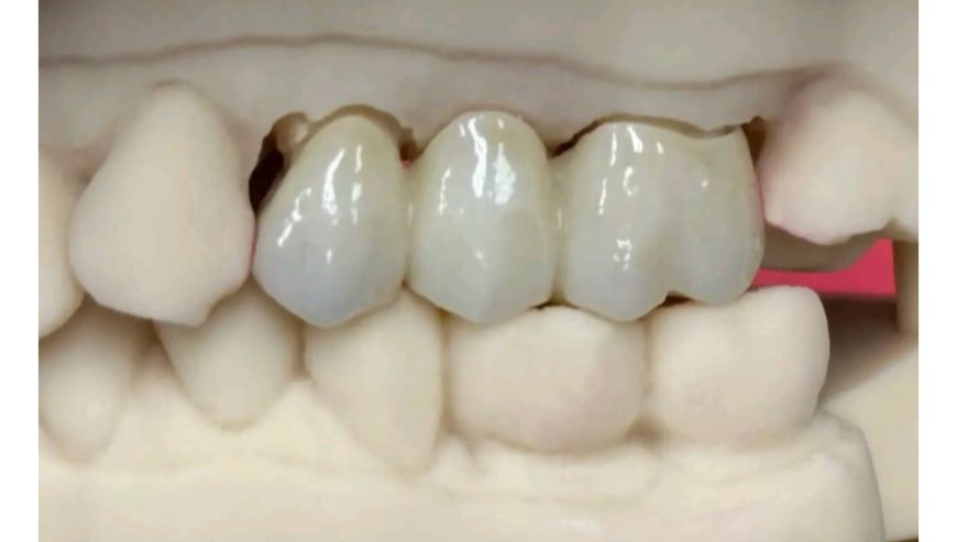 Teeth replacement kampala