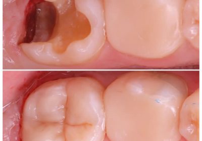 Treatment for teeth in kampala