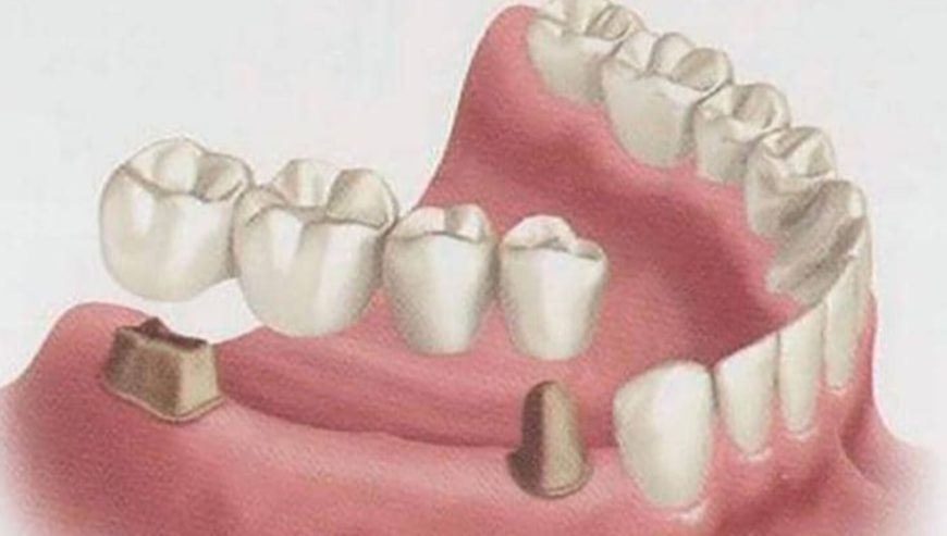 Artificial teeth replacement near me