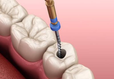 Root canal treatment near me