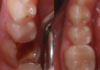 Treatment of teeth with holes in kampala