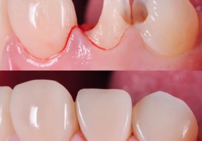 Tooth filling near me