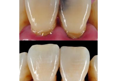 Teeth decay treatment in wandegeya