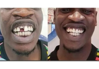 Dental teeth replacement around wandegeya