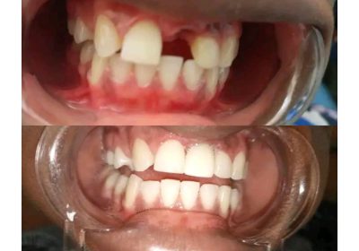 Teeth replacement with a dental bridge in kampala near me