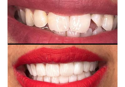Teeth shape correction in kampala