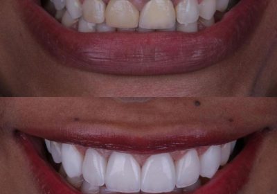 Teeth whitening with crowns in kampala