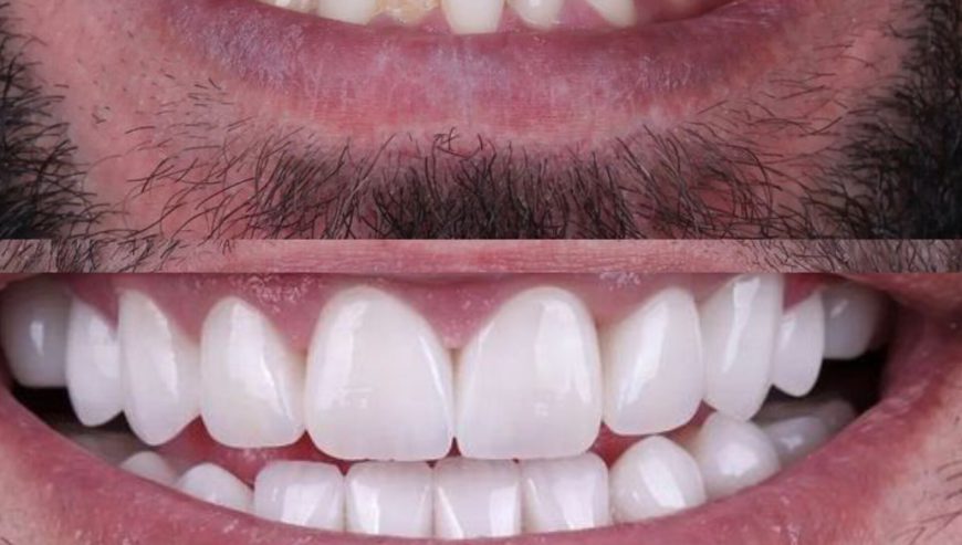 Teeth lengthening in kampala