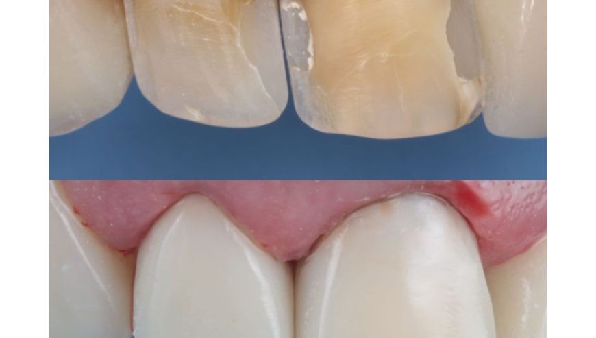 Teeth treatment near wandegeya
